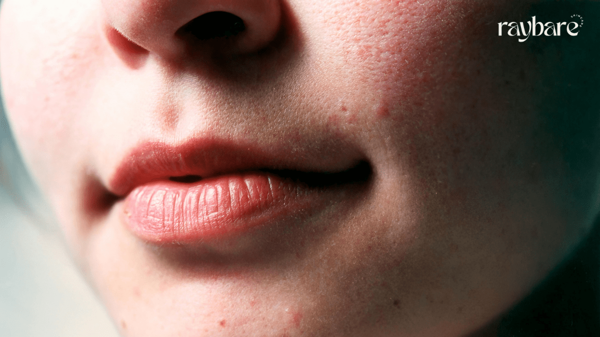 https://raybare.com/myeloma-skin-rash/
